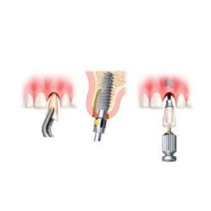 Implantes inmediatos DentalGalindo