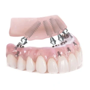 all on 4 Tident Dentistas en Miajadas