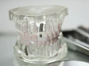 implantes tratamientos Tident Dentistas en Miajadas