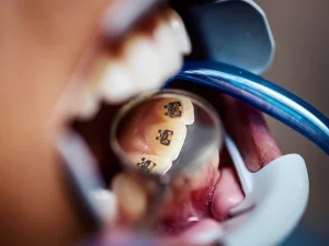 ortodoncia tratamiento Tident Dentistas en Miajadas