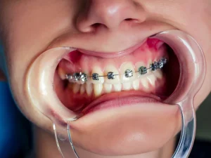 ortodoncia tratamiento Tident Dentistas en Miajadas