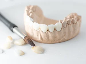 estetica tratamiento carillas Tident Dentistas en Miajadas